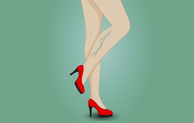 Spataderen op de benen van een vrouw