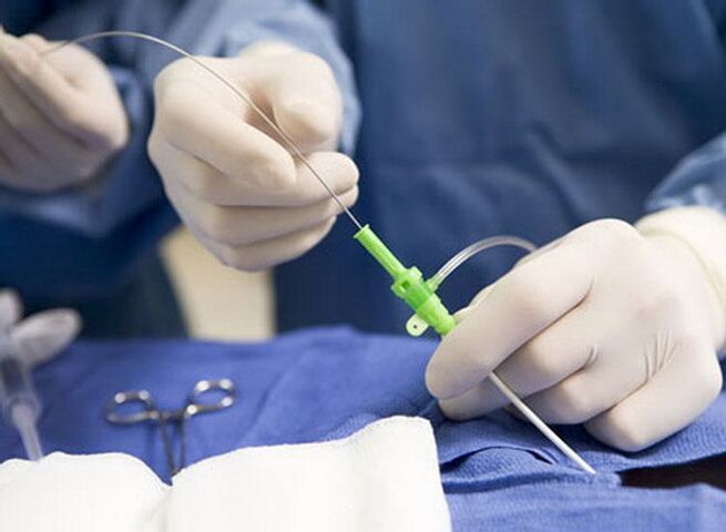 Radiofrequente ablatie