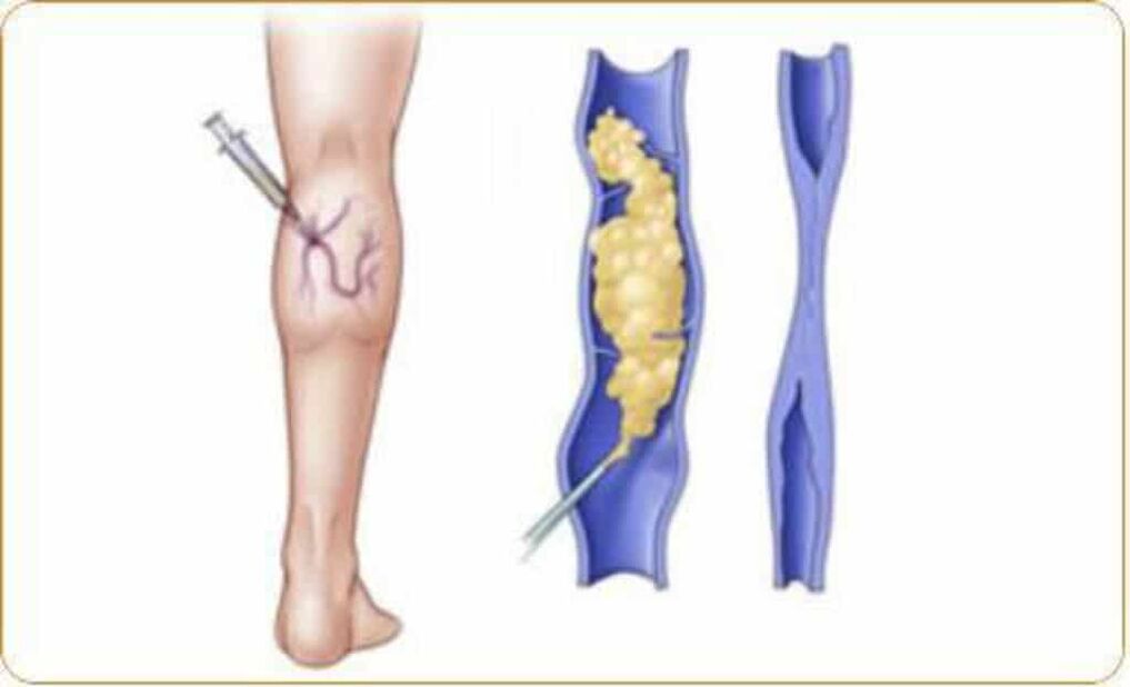 Een voorbeeld van de sclerotherapieprocedure voor spataderen en een duidelijk resultaat